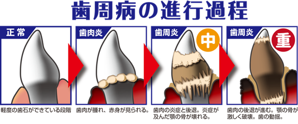 １１ 月 ８日（月）「いい歯の日」３歳以上のペット約８割が歯周病予備軍『愛犬の健康寿命のための歯磨き教室』大田区ペット保護・譲渡施設で開講のサブ画像2_歯周病の進行過程